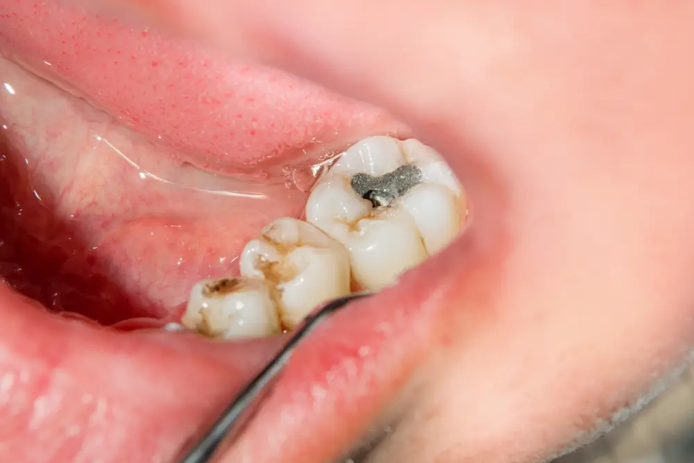 How do you Know if you have a Rotten Tooth?