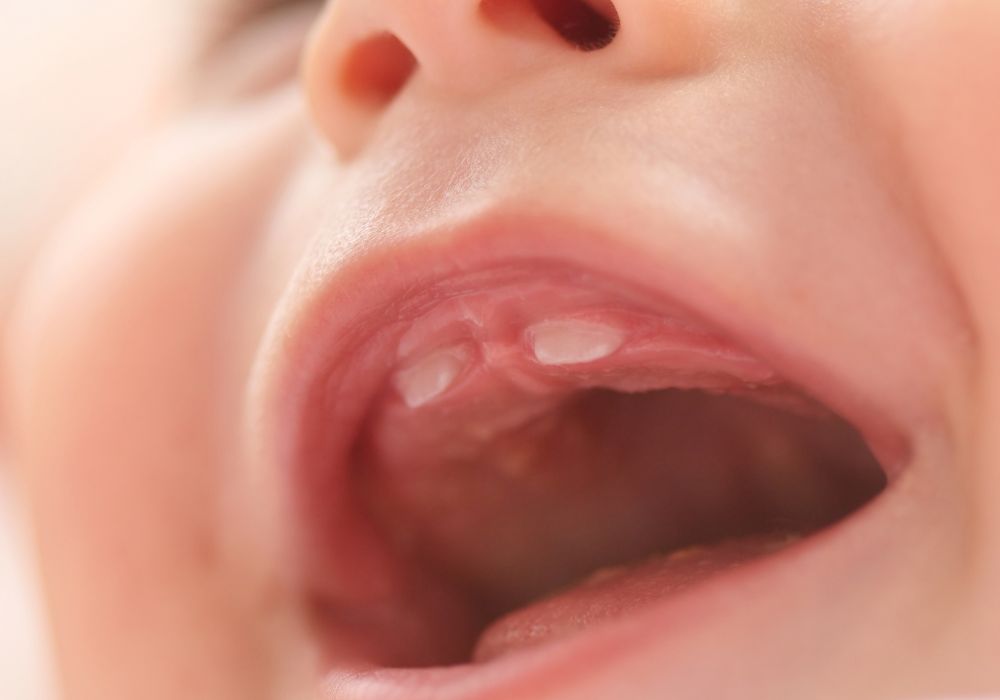 neonatal teeth